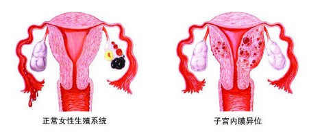 子宫内膜异位症会导致不孕吗?